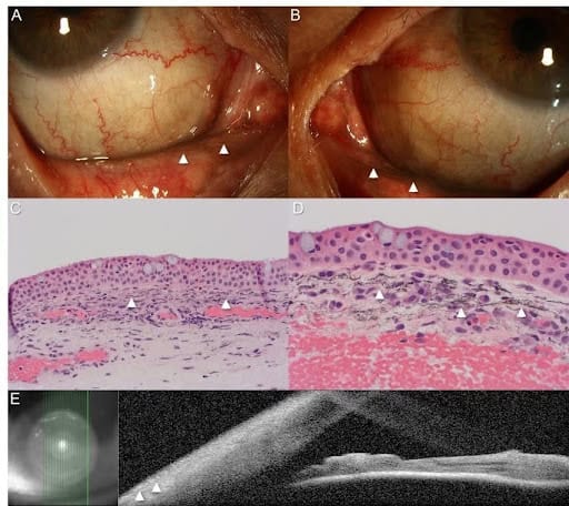 figure 1 argyrosis composite