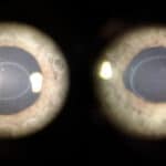 Bilateral Idiopathic Corneal Ring Opacity (Ascher Ring)
