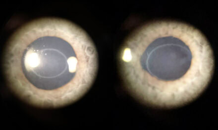 Bilateral Idiopathic Corneal Ring Opacity (Ascher Ring)