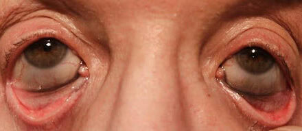 Argyrosis: A Case Of Caruncle And Conjunctival Discoloration Due To Homeopathic Colloidal Silver Eye Drops