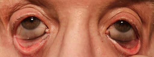 Argyrosis: A Case Of Caruncle And Conjunctival Discoloration Due To Homeopathic Colloidal Silver Eye Drops