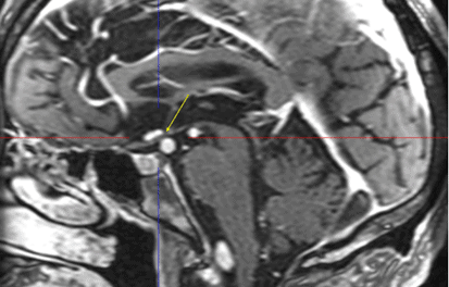 Dolicoectatic Compression of the Optic Tract: A Case Report