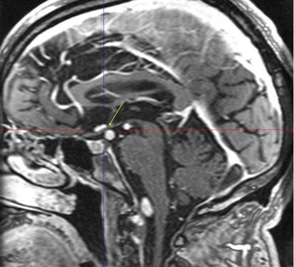 Dolicoectatic Compression of the Optic Tract: A Case Report
