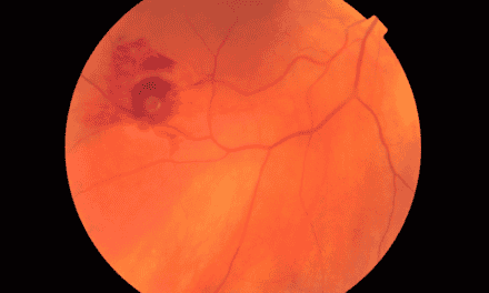 Management of a Retinal Arterial Macroaneurysm