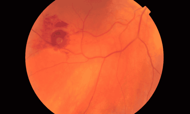 Management of a Retinal Arterial Macroaneurysm