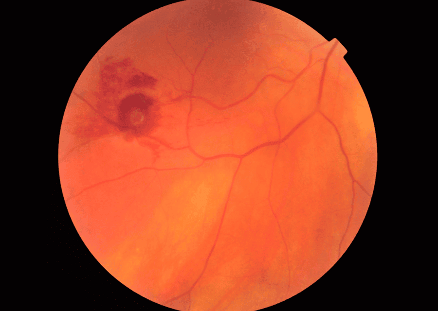 Management of a Retinal Arterial Macroaneurysm