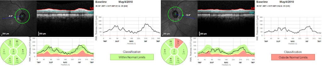 Figure 1a. Baseline RNFL OCT of the OD (left). Figure 1b. Baseline RNFL OCT of the OS (right)
