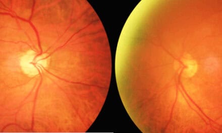 The Phenomenon of Quiescent Tomographically-Detected Macular Neovascularization
