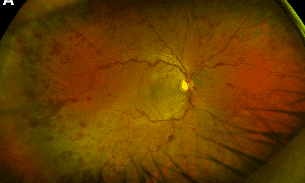 Hyperviscosity-Related Retinopathy and Serous Macular Detachment in Waldenstrӧm Macroglobulinemia Managed With Zanubrutinib