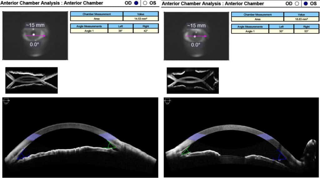 figure 1 angle od and figure 2 angle os