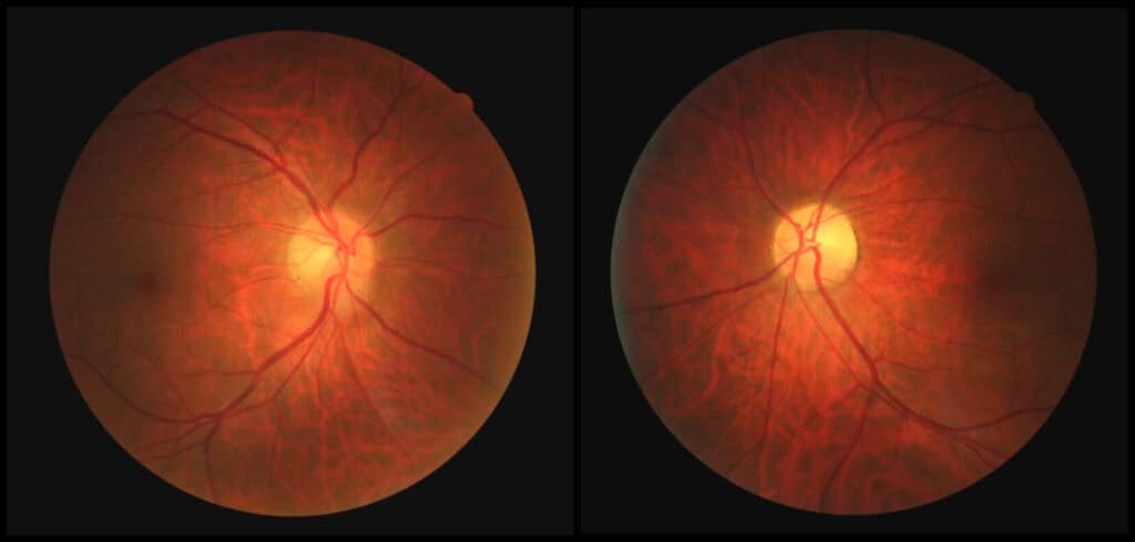 figure 1 fundus photo od