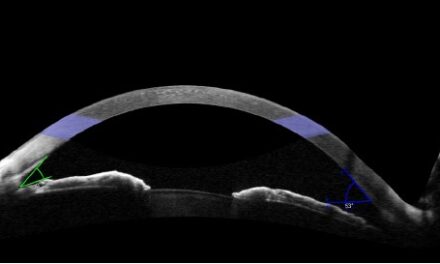 Posner-Schlossman Syndrome