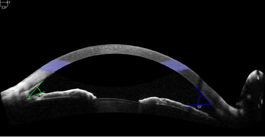 Posner-Schlossman Syndrome