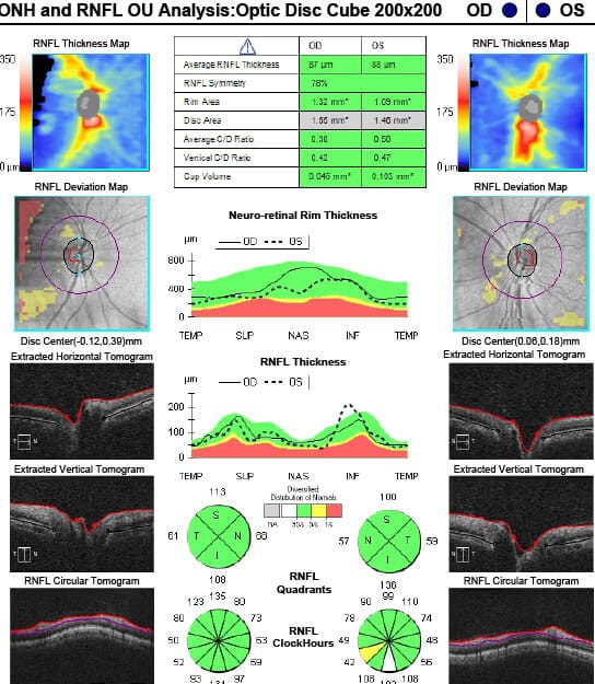 figure 3 oct rnfl ou (1)