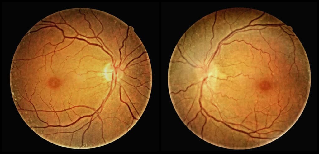 figure 4 fundus photo od (1)