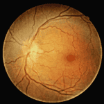 Incipient NAION vs Classic NAION with Vision Loss