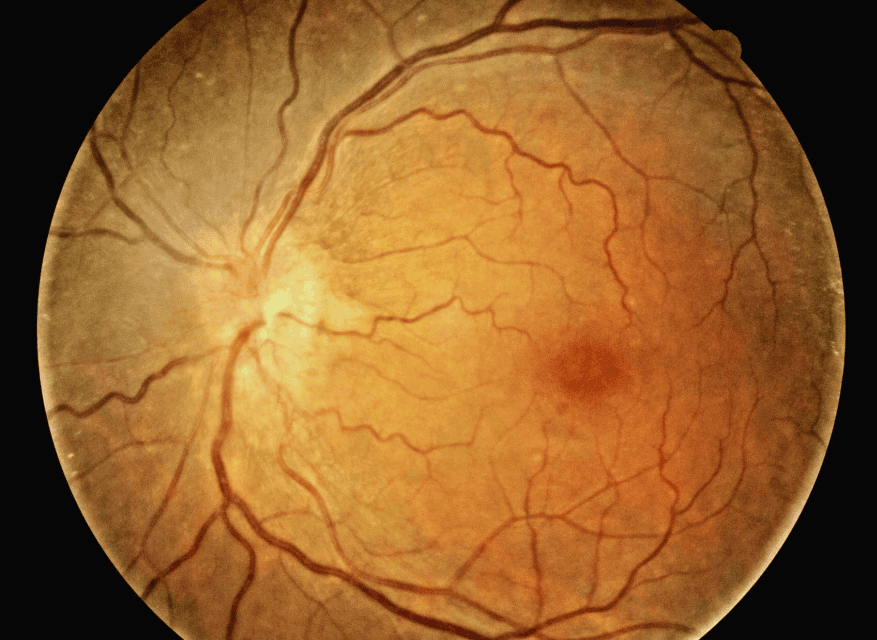 Incipient NAION vs Classic NAION with Vision Loss