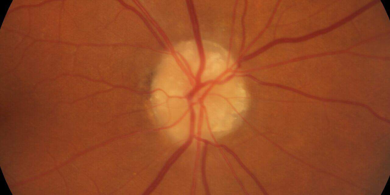 Impact of Diabetes on Visual Function in Veterans with Optic Disc Drusen: A Comparative Study
