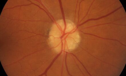 Impact of Diabetes on Visual Function in Veterans with Optic Disc Drusen: A Comparative Study