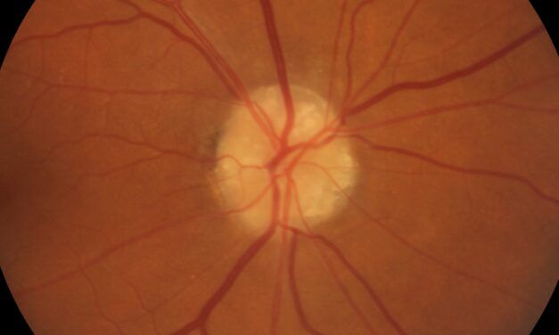 Impact of Diabetes on Visual Function in Veterans with Optic Disc Drusen: A Comparative Study