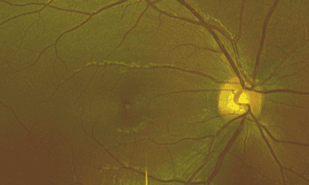 Multimodal Imaging in the Diagnosis of Solar Retinopathy Secondary to Viewing Solar Eclipse with Inadequate Eye Protection