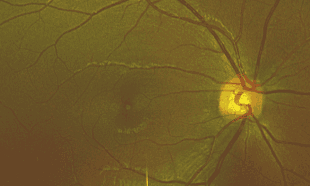 Multimodal Imaging in the Diagnosis of Solar Retinopathy Secondary to Viewing Solar Eclipse with Inadequate Eye Protection