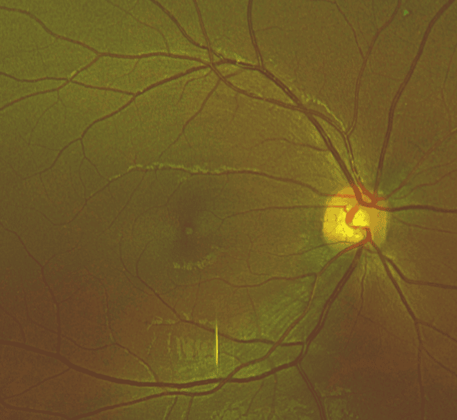 Multimodal Imaging in the Diagnosis of Solar Retinopathy Secondary to Viewing Solar Eclipse with Inadequate Eye Protection