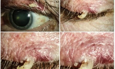 PHOTO ESSAY: Just A Cutaneous Horn or Squamous Cell Carcinoma?