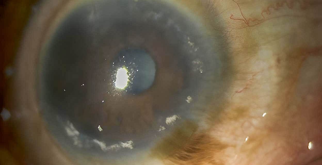 Contact Lens Induced Limbal Stem Cell Deficiency