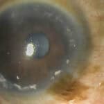 Contact Lens Induced Limbal Stem Cell Deficiency