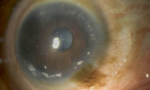 Contact Lens Induced Limbal Stem Cell Deficiency