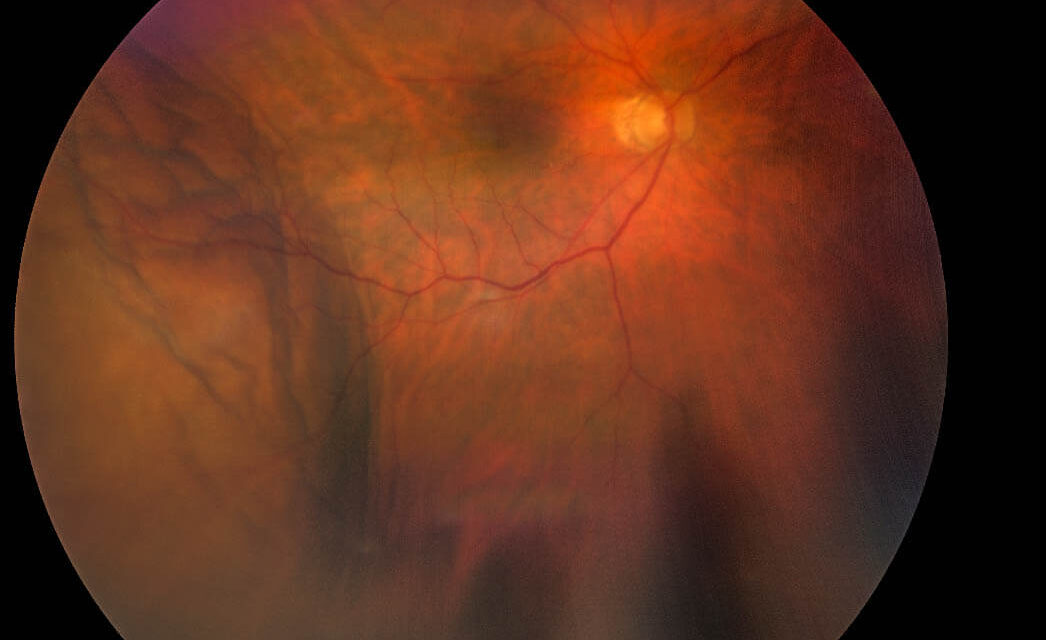 Post-operative Hypotony And Choroidal Effusion Following Cataract Surgery Suture Removal