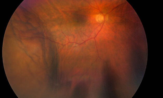 Post-operative Hypotony And Choroidal Effusion Following Cataract Surgery Suture Removal