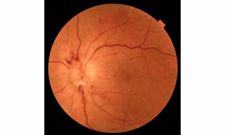 Overtreated Hypertension Results in Sequential Nonarteritic Ischemic Optic Neuropathy