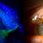 Infectious Keratitis in a Neurotrophic Cornea