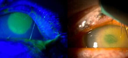 Infectious Keratitis in a Neurotrophic Cornea