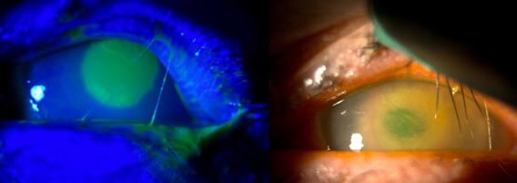 Infectious Keratitis in a Neurotrophic Cornea