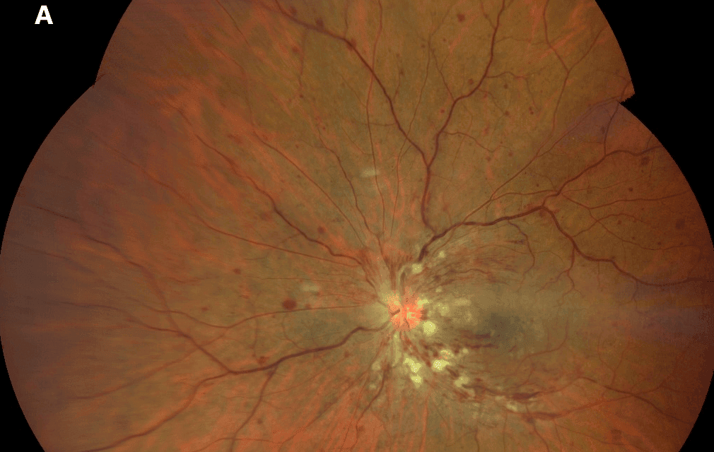 Assessing Risk of Neovascular Sequelae in Central Retinal Vein Occlusion