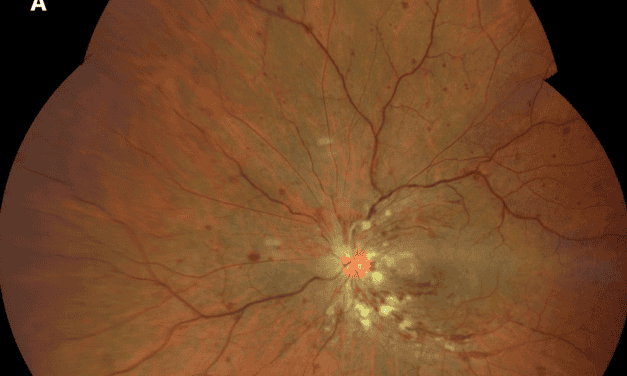 Assessing Risk of Neovascular Sequelae in Central Retinal Vein Occlusion