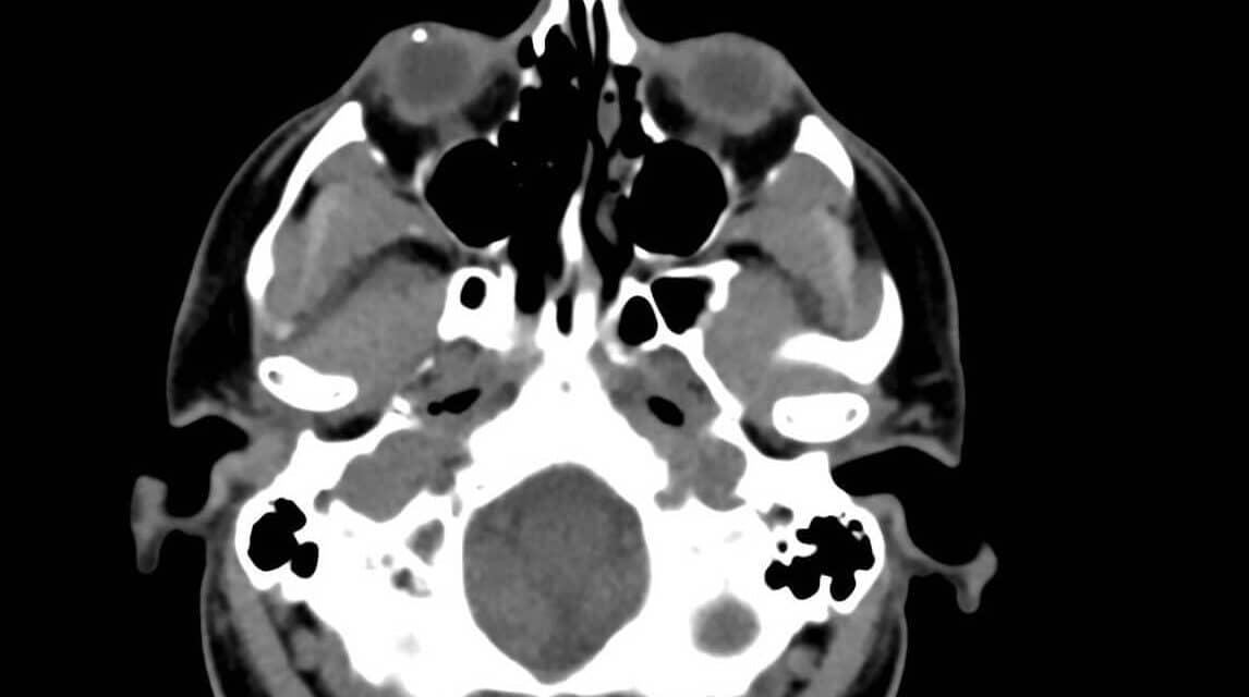 PHOTO ESSAY: Management of Penetrating Injuries and Intraocular Foreign Bodies