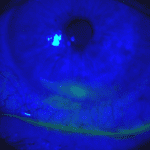 A Case of Paralytic Lagophthalmos Following Melanoma Surgery Induced Seventh Nerve Palsy