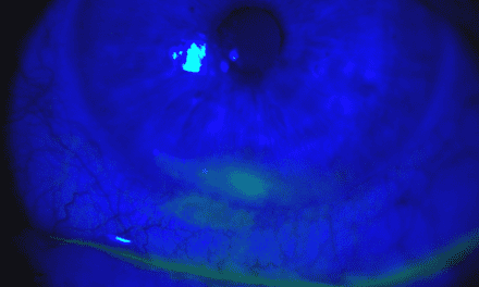 A Case of Paralytic Lagophthalmos Following Melanoma Surgery Induced Seventh Nerve Palsy