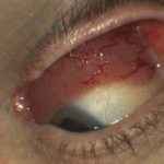 Mucosa Associated Lymphoid Tissue (MALT): A Clinical Overview of Orbital Lymphoma