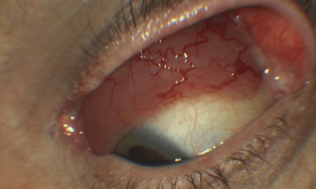 Mucosa Associated Lymphoid Tissue (MALT): A Clinical Overview of Orbital Lymphoma