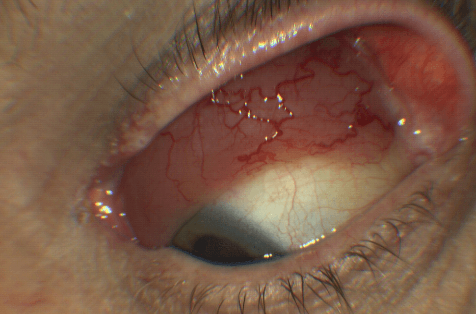 Mucosa Associated Lymphoid Tissue (MALT): A Clinical Overview of Orbital Lymphoma