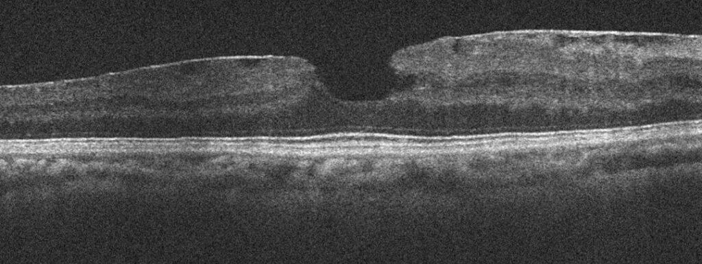myotonic dystrophy figure 2 (1)