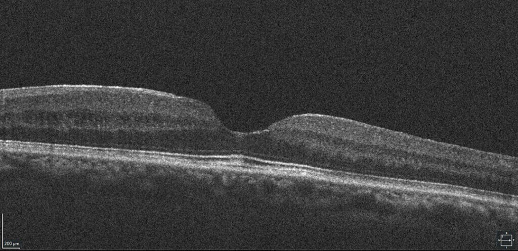 myotonic dystrophy figure 3 (1)