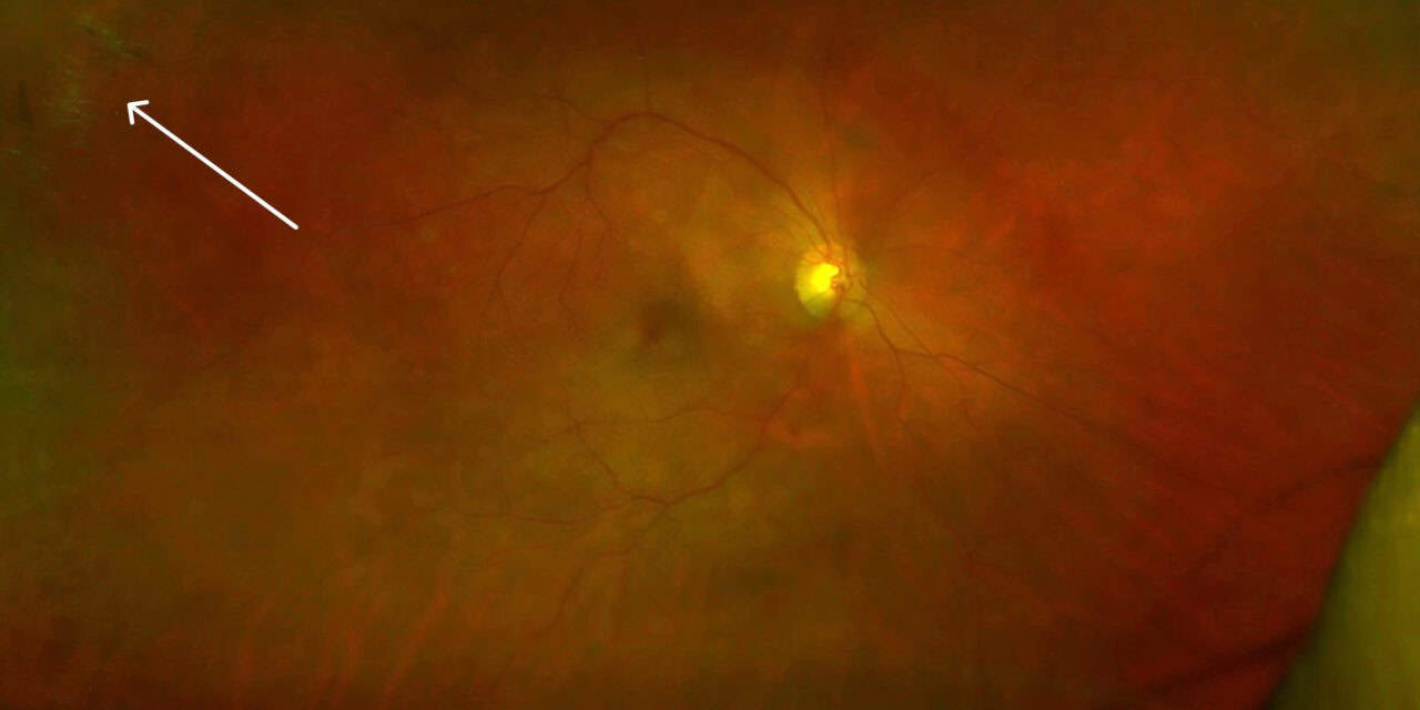 Ocular Findings in a Patient with Type 1 Myotonic Dystrophy: A Case Report