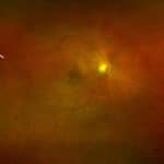 Ocular Findings in a Patient with Type 1 Myotonic Dystrophy: A Case Report