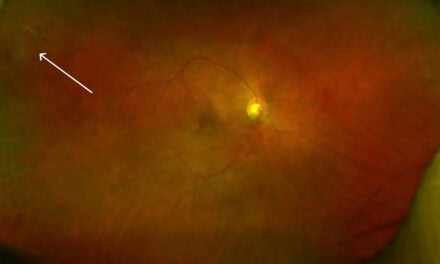 Ocular Findings in a Patient with Type 1 Myotonic Dystrophy: A Case Report